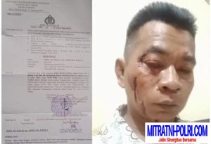 Hampir Tewas Wartawan Jadi Korban Pengeroyokan, Polres Sumenep Diduga Setting dan Rekayasa Terlapor Laporan Balik.